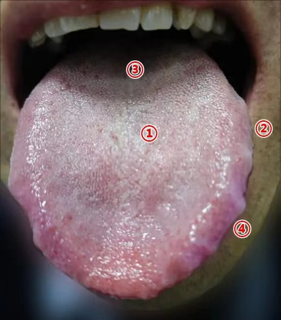 之前来的这位患者来问:自己舌苔淡白,确定是肾阳虚,吃哪种中成药? ?