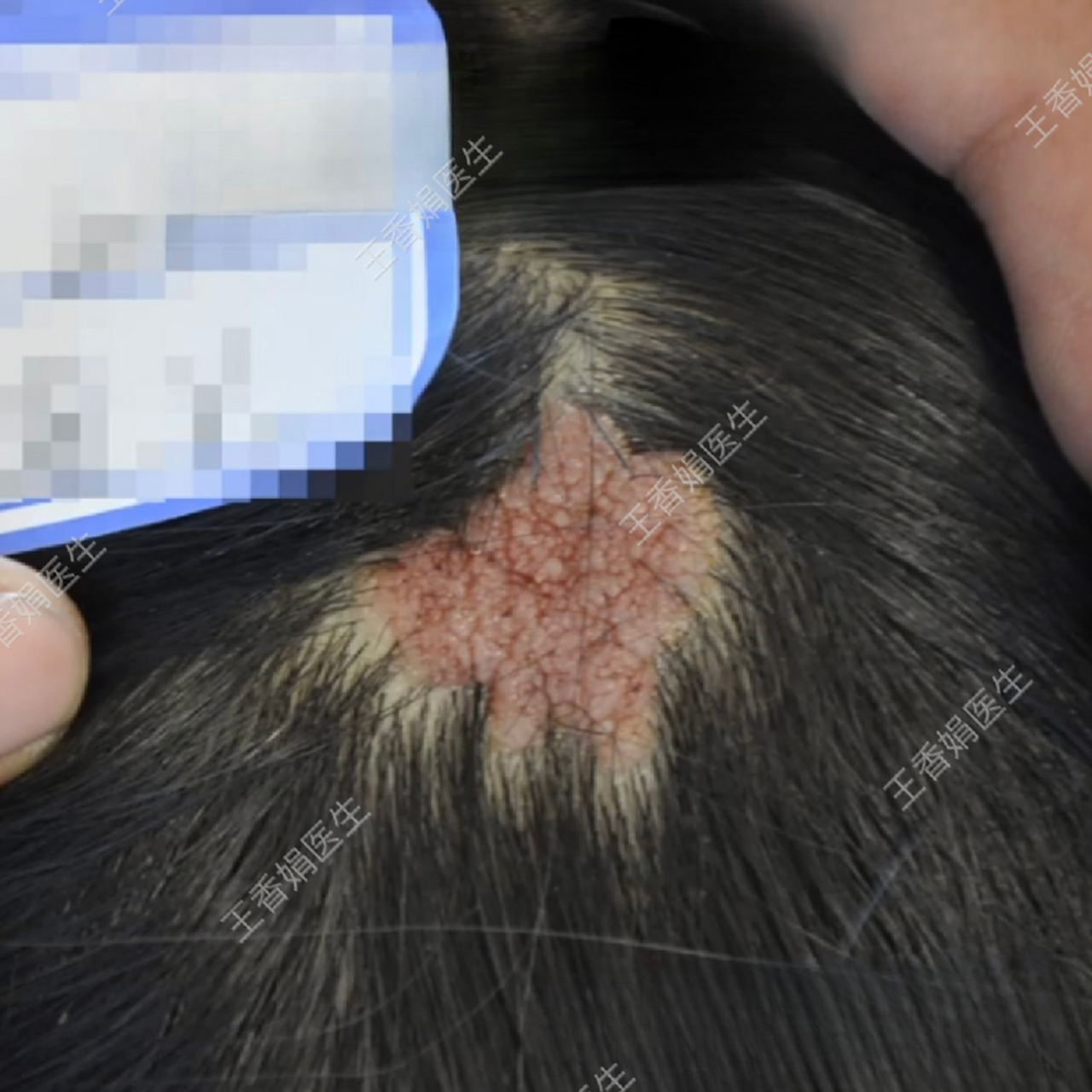 孩子头上不长头发,可能是这种胎记!