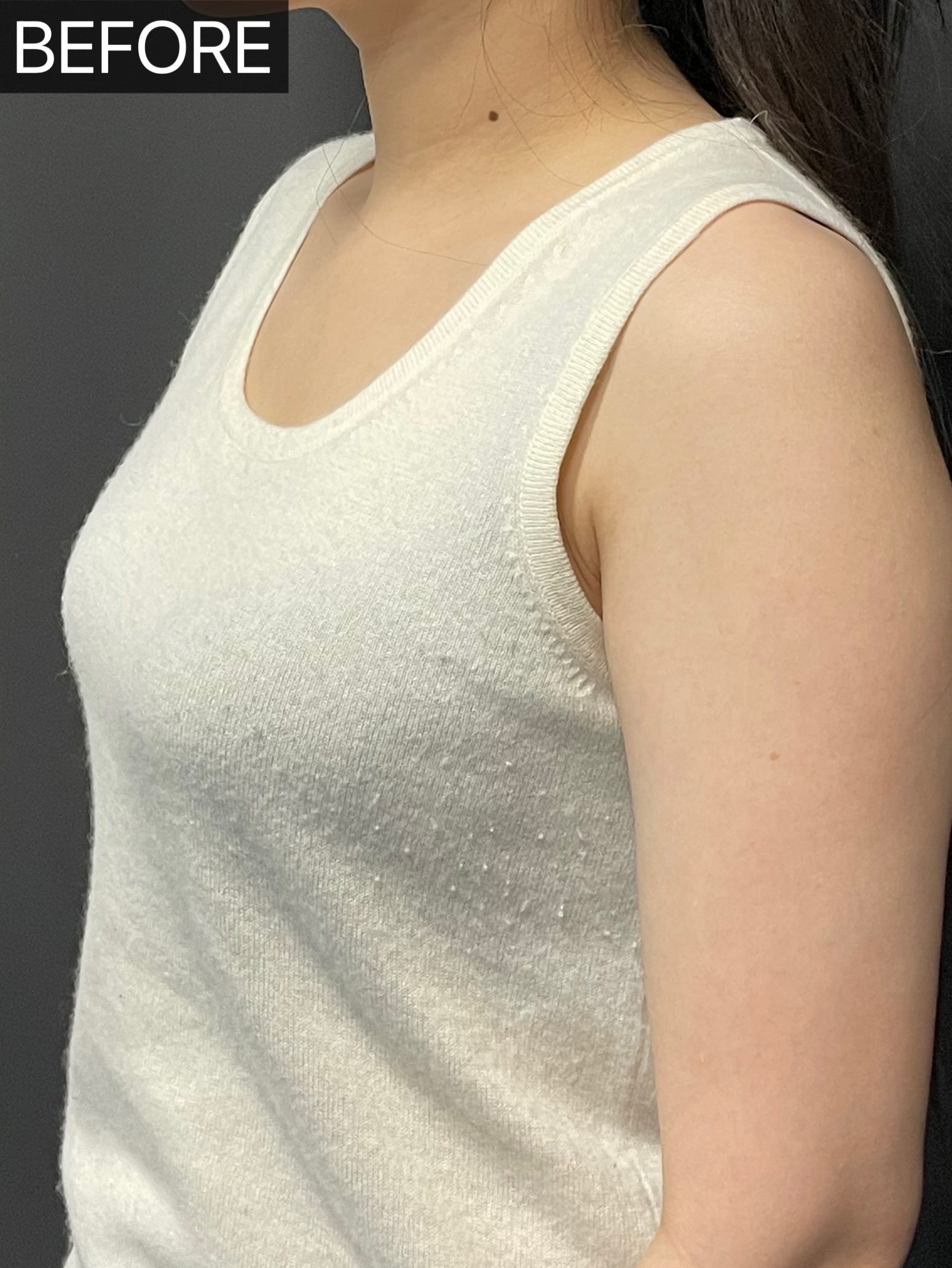 33岁宝妈生育3次,胸部下垂,空杯,想通过丰胸手术找回自信