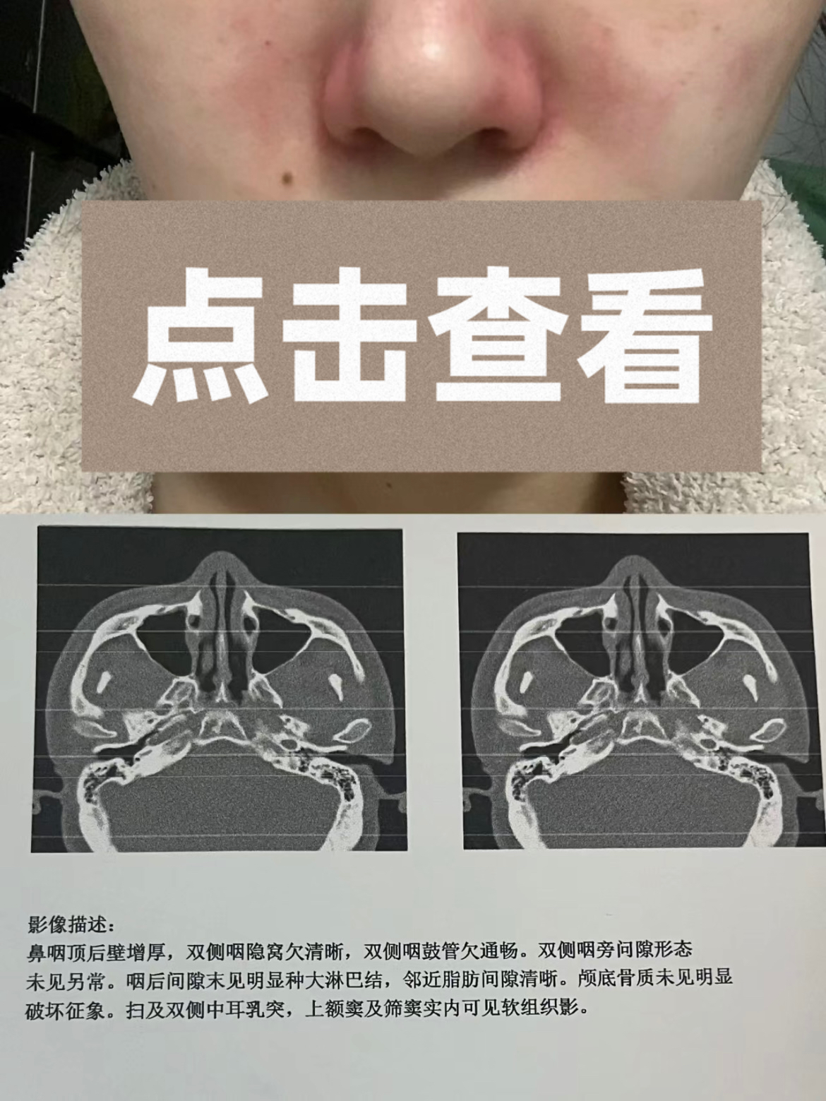 这3个原因让过敏性鼻炎总发作看看你中了吗?