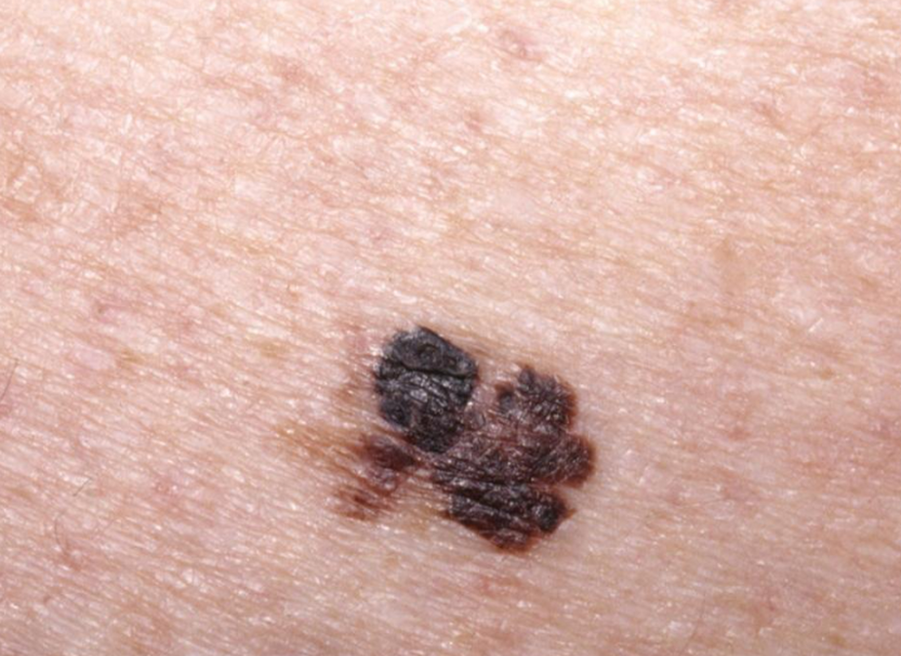 屁股上长黑痦子是什么情况?