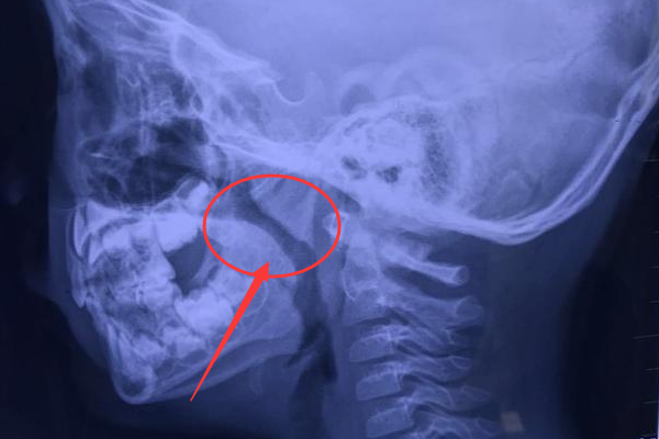 腺样体肥大,一场不必要的战役,为何要给孩子动刀?