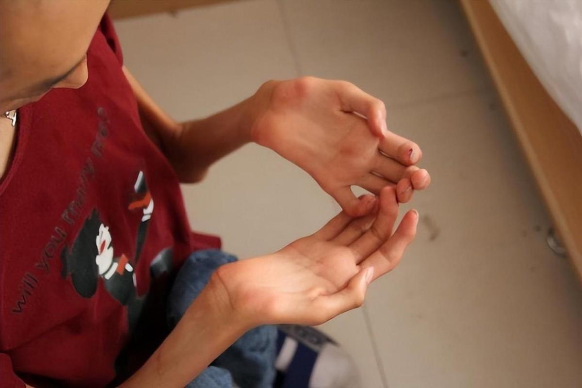 他16岁确诊渐冻症,30岁娶了漂亮媳妇,如今过得咋样?