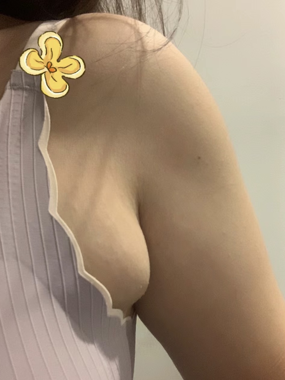 姑娘割完副乳后,后悔道:我.@甲乳外科蒋安科的动态