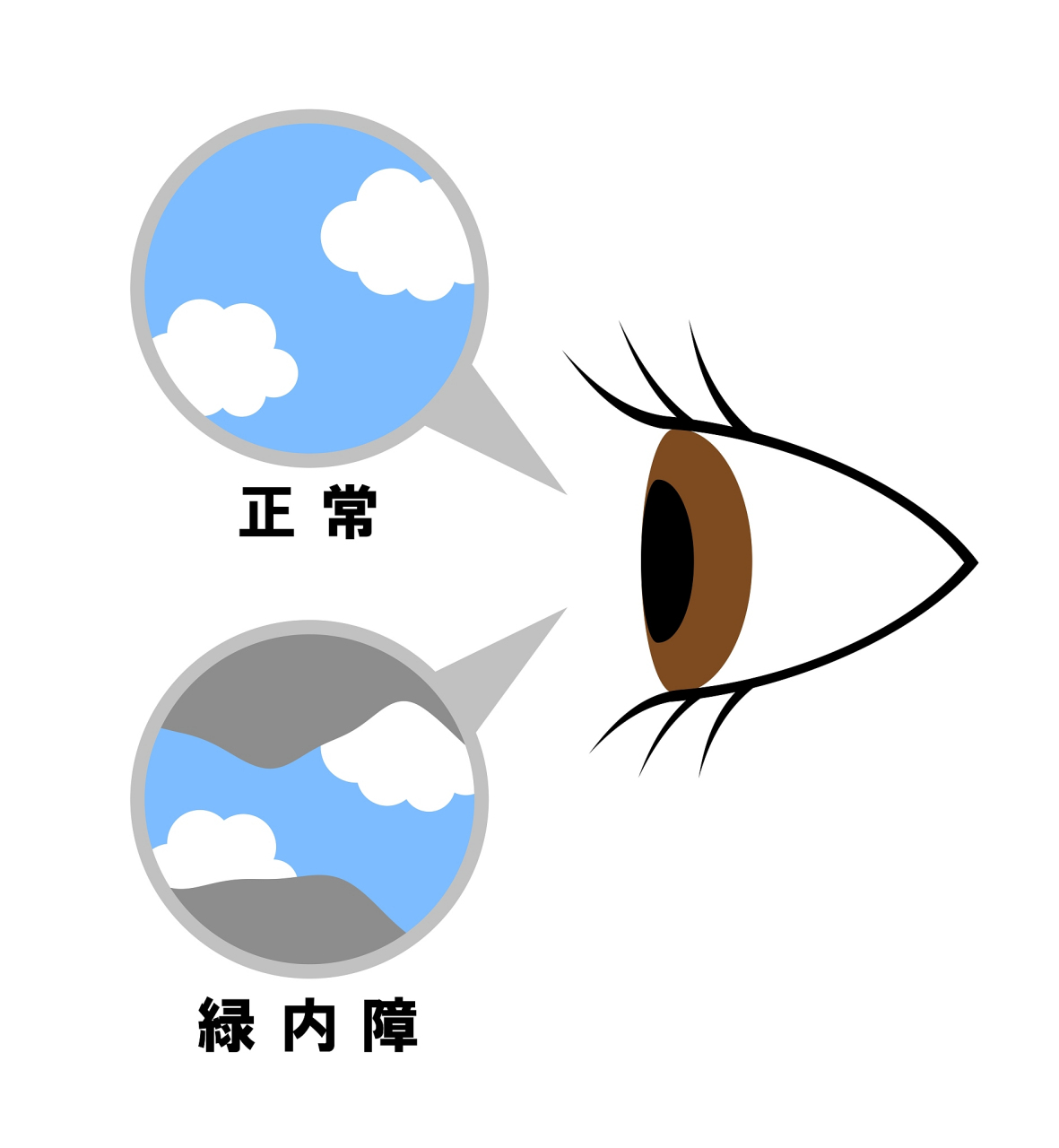 青光眼治疗通常是一个长期的过程,需要患者积极配合医生的治疗.
