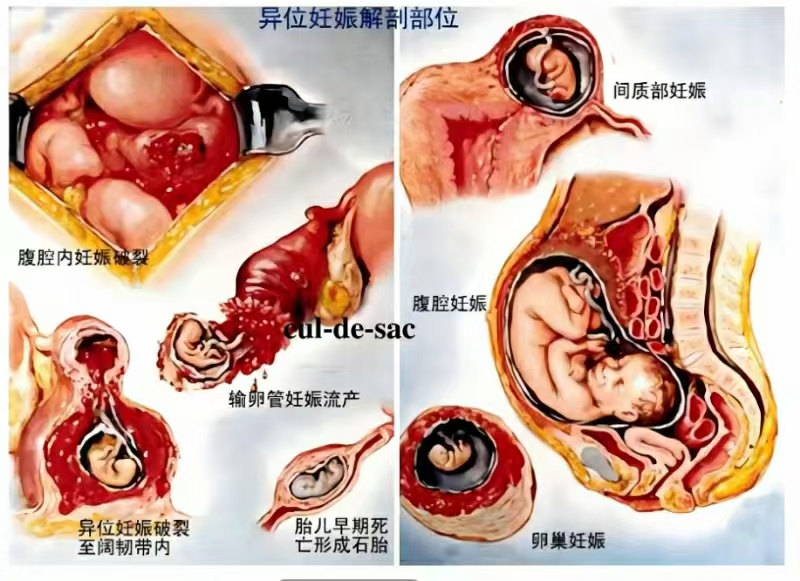 输卵管间质部妊娠图片图片