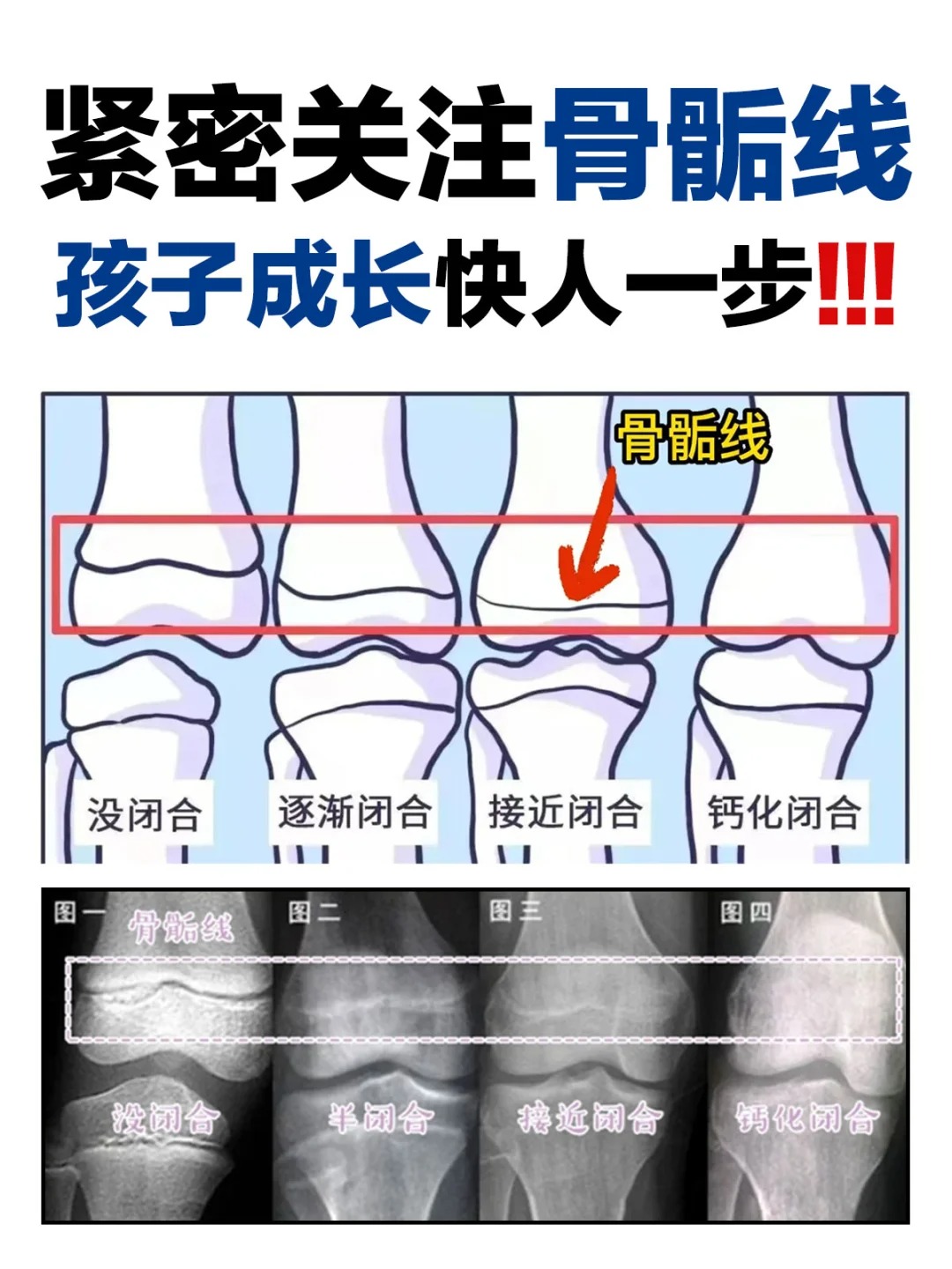 腓骨骨骺线图片