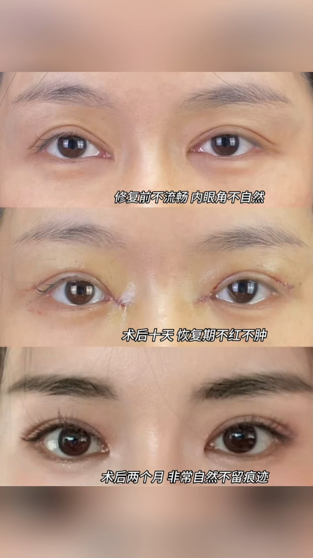 34岁做眼周年轻化修复双眼皮,内眼角回包,自然放大双眼,不住院不留痕