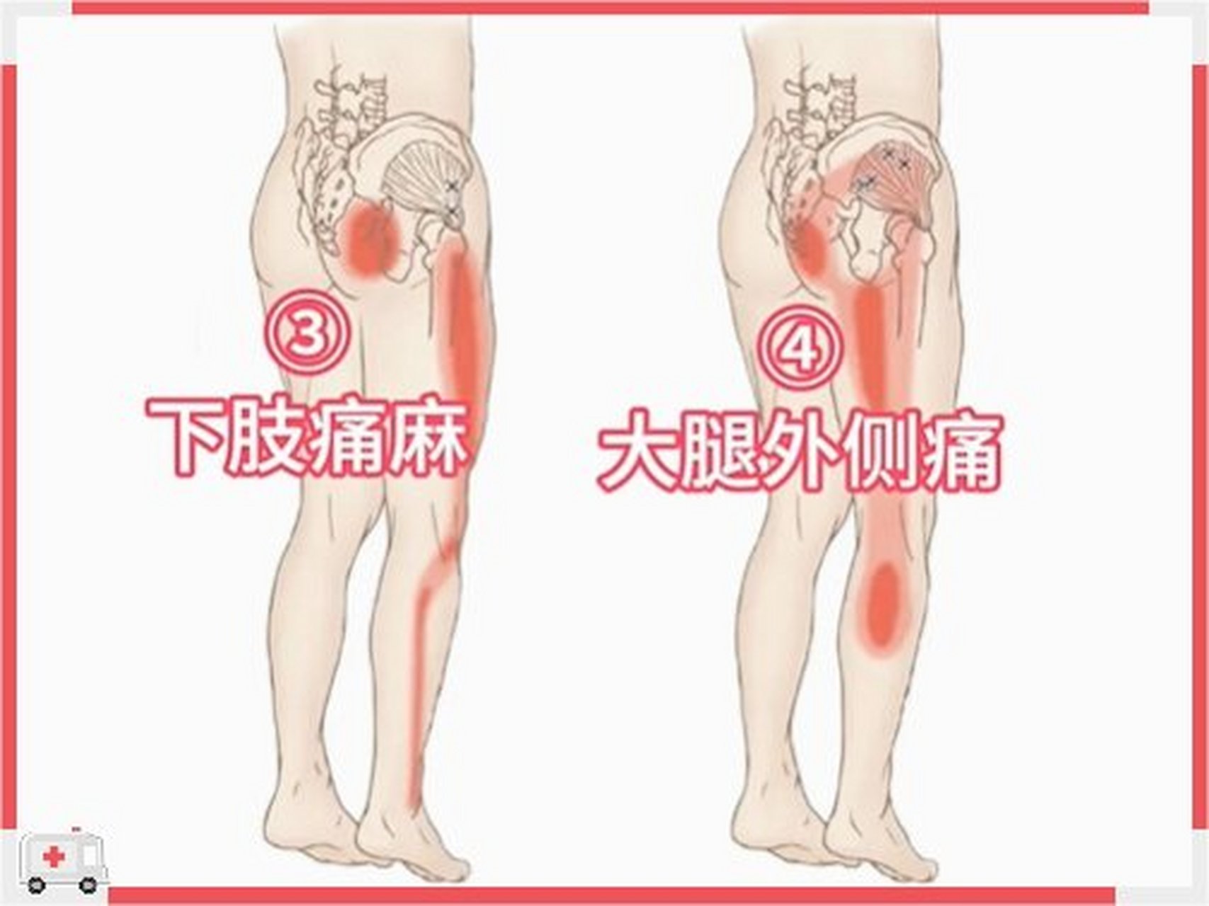 女性大腿根疼是咋回事图片