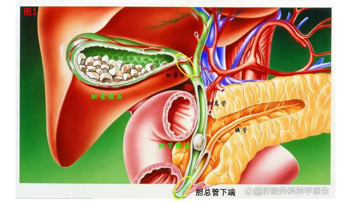 胆总管分为哪四段图片图片