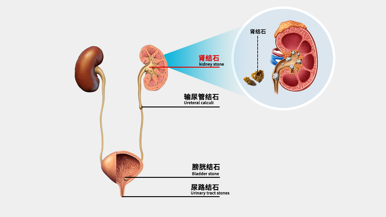 肾结石排石图解图片