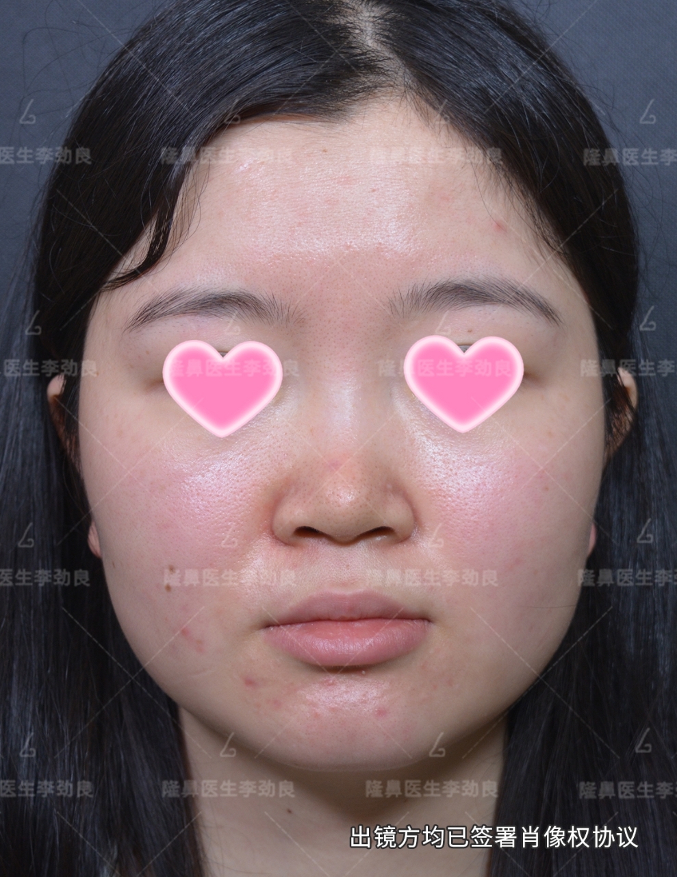 术后半年复查,苹果原相机拍摄.前后对比明显,凹面脸变凸面脸