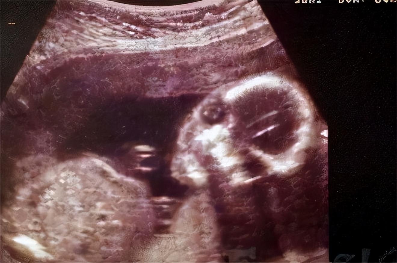 12周婴儿胚胎图片图片