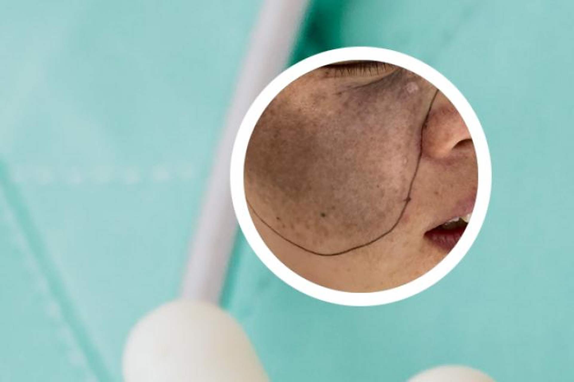 青色胎记是常见的胎记类型之一,那么,哪些胎记属于青胎记呢?