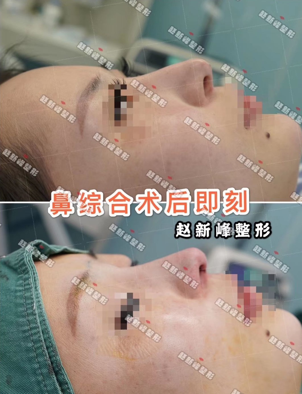 先看这个案例:姑娘术前虽然鼻梁有一定的高度,但是过于生硬,鼻唇角