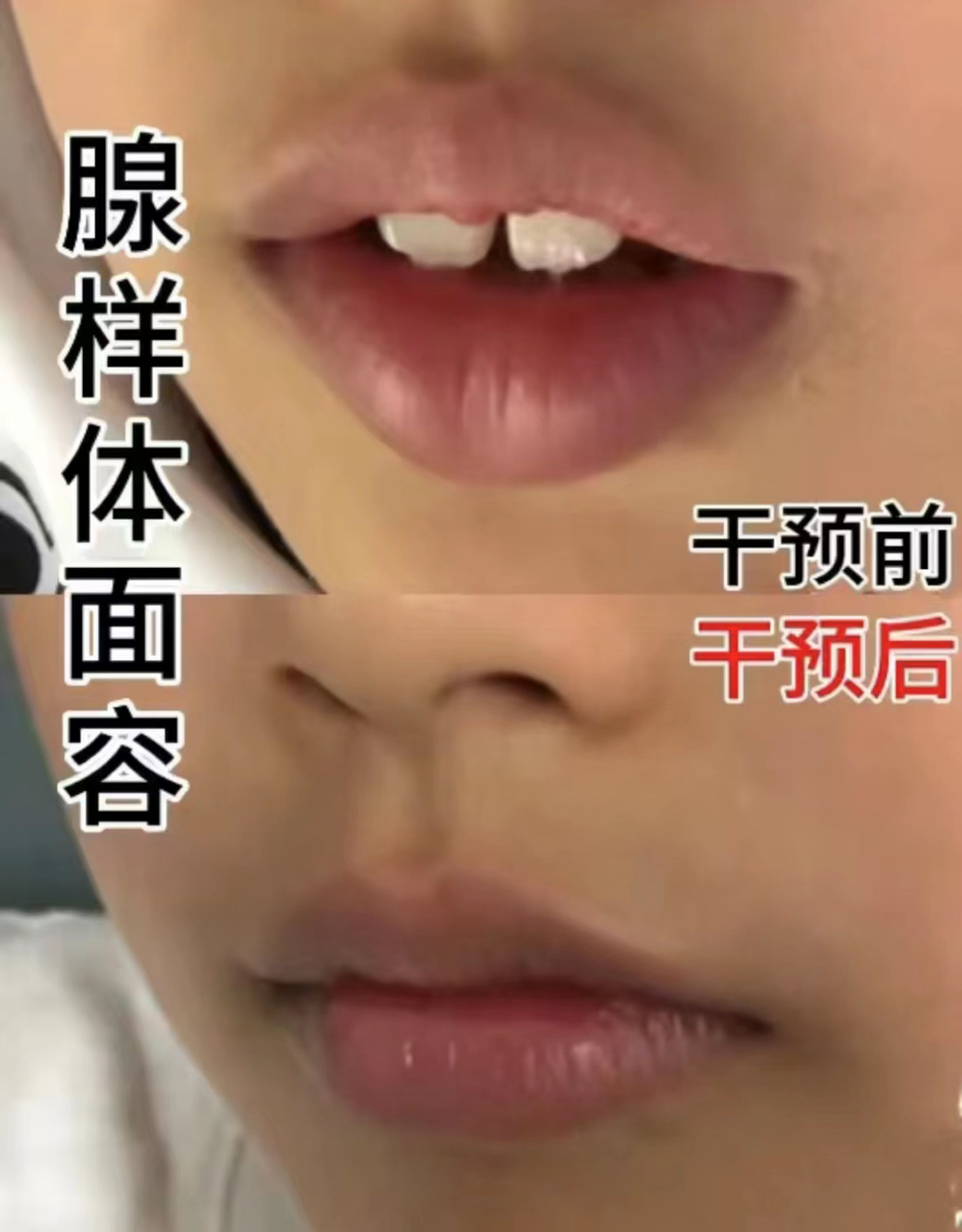 孩子腺样体肥大越来越受家长重视,因为它确实可能影响孩子的面容.