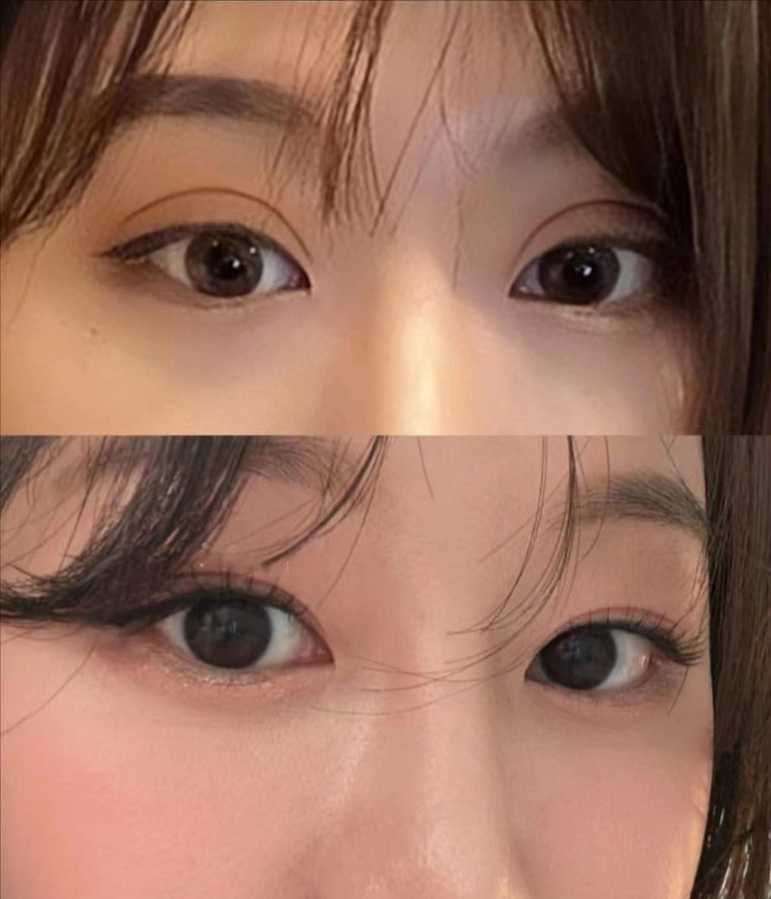 欧式大宽改扇形,拥有更减龄的双眼皮!