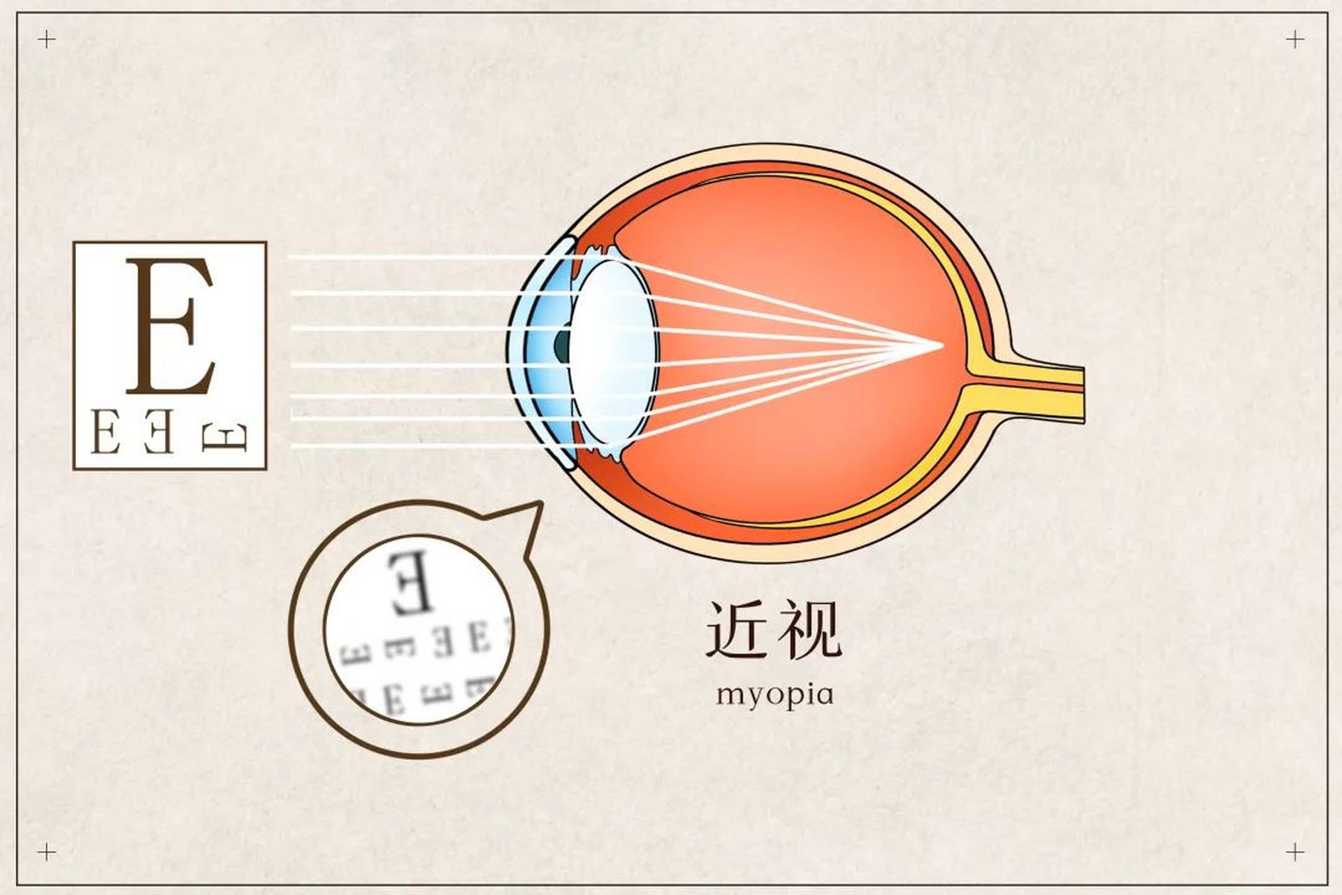 儿童近视是假性近视还是真性近视,不能单凭电脑验光结果判断.