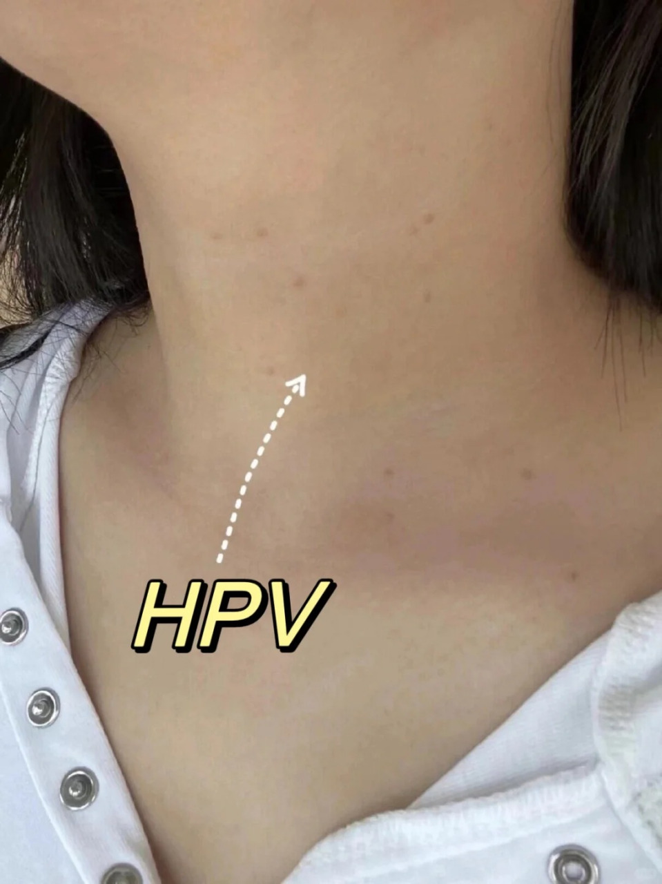 对于年轻女性来说,感染hpv病毒可能带来哪些影响:  1,无症状载体:许多