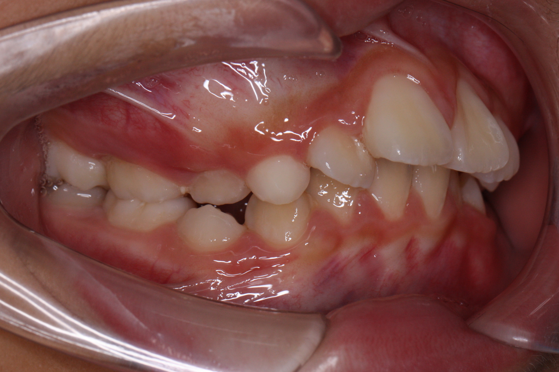 孩子龅牙嘴突,想要恢复正常,又不想拔牙矫正,这是我们所有家长的心愿.