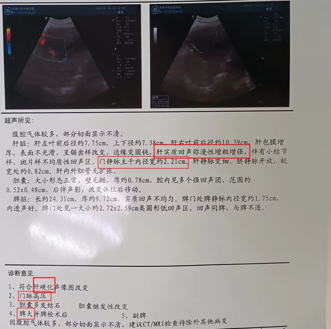 肝脏b超出现这5种提示,一定要警惕肝硬化!