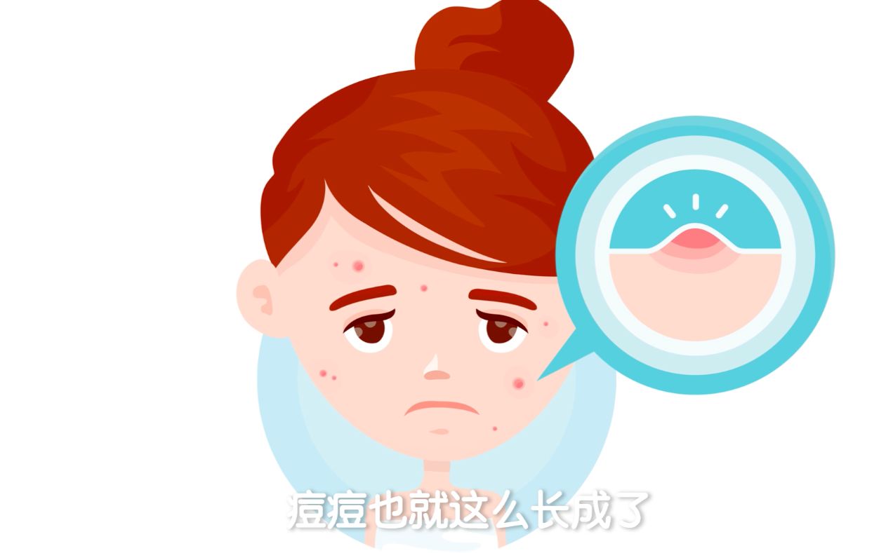 关于痘痘的这5大误区