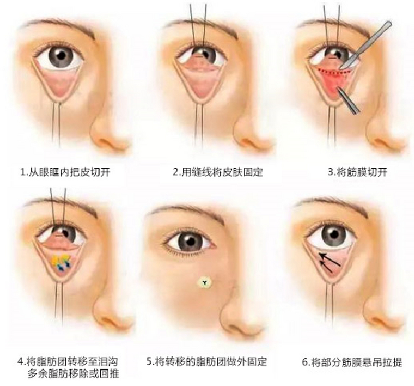 眶隔脂肪释放术后脂肪会移位吗?