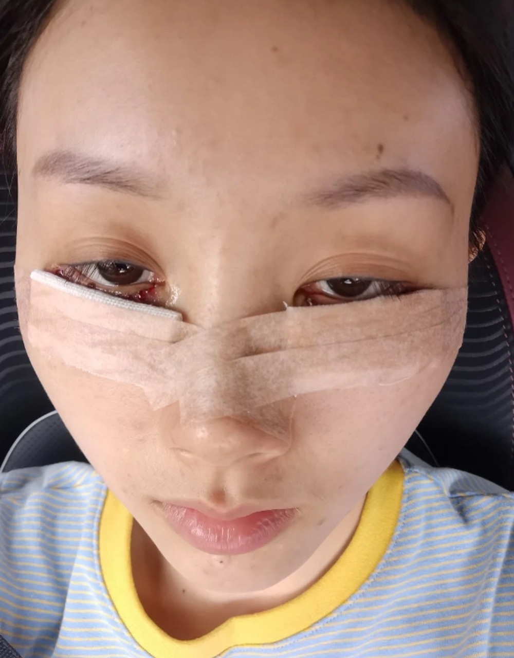 【真实案例分享】眼眶隔脂肪释放手术已经过去两个月啦!