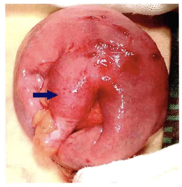 小儿美克尔憩室