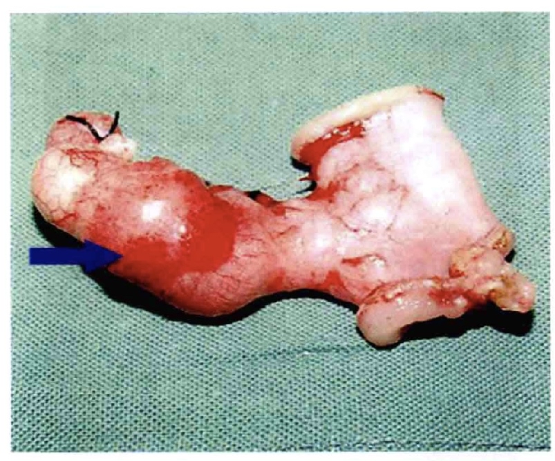 小儿美克尔憩室