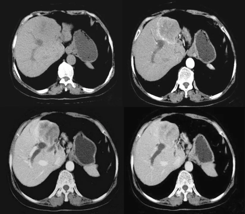 第一肝囊肿,肝囊肿绝大部分是不需要处理的,一般情况下大约5个公肪屯