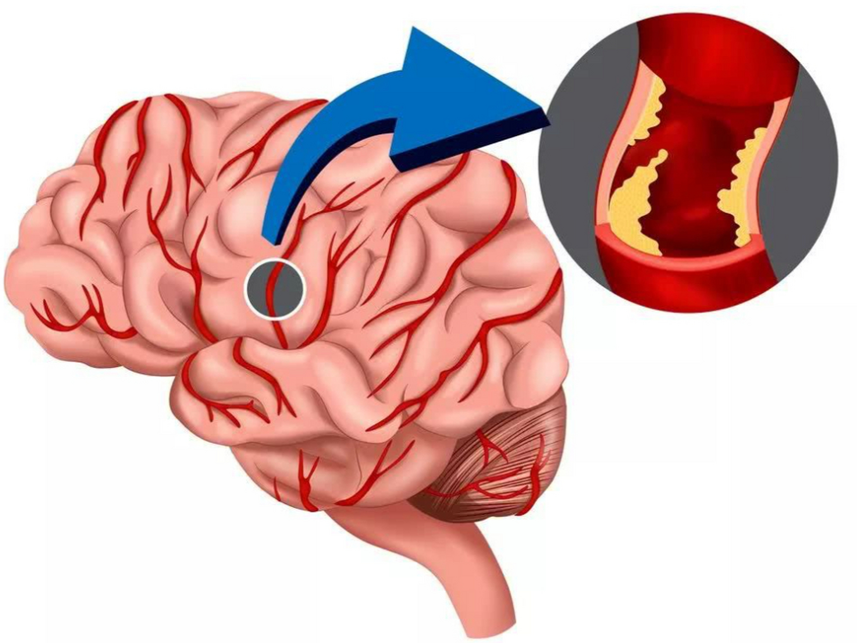 脑供血不足,氟桂利嗪,血塞通它们有何不同,要怎么选?
