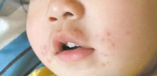 原来螨虫最大"天敌"不是暴晒?教你1个"土"法子,螨虫"跑光了"