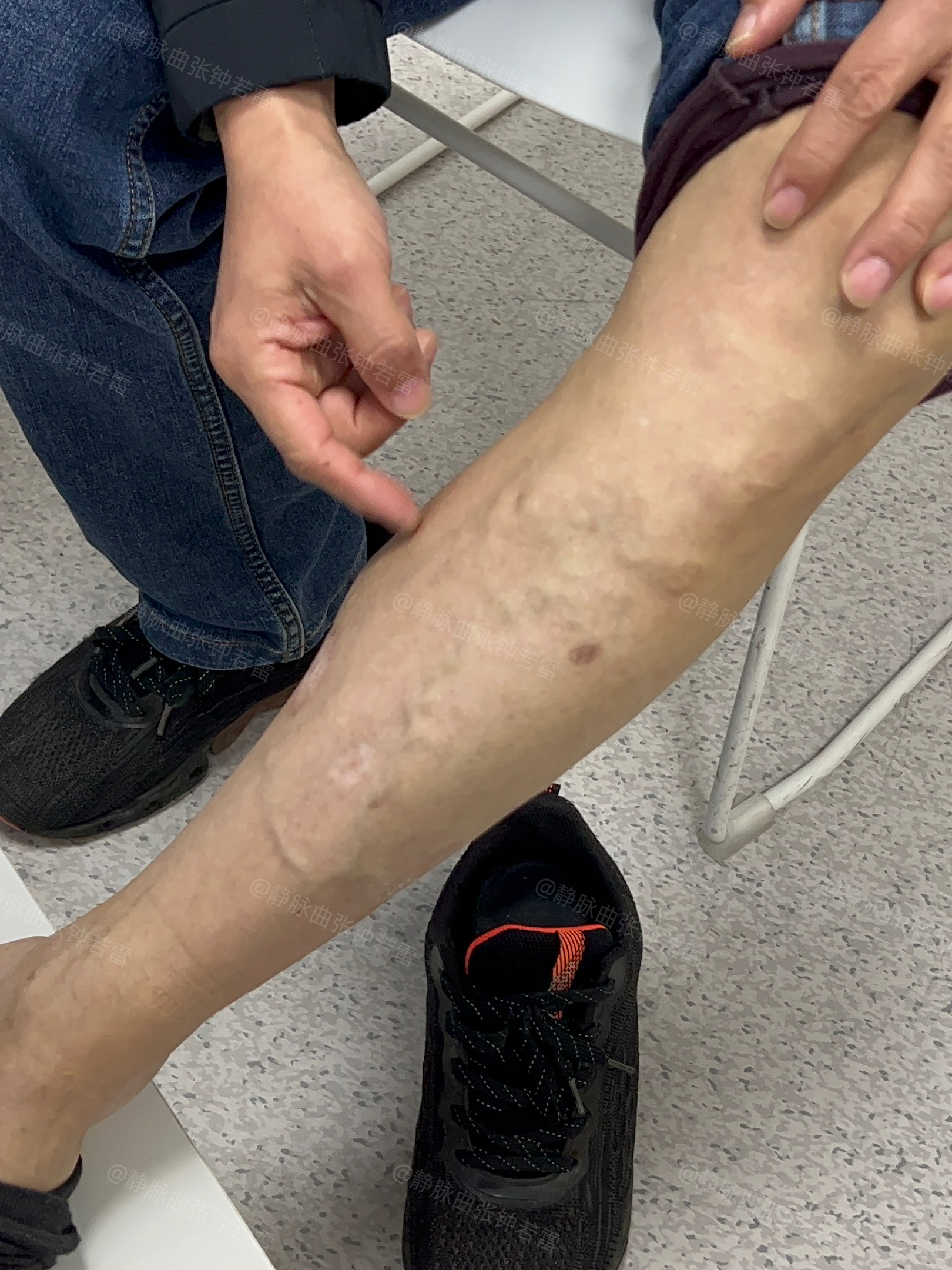 63岁大哥静脉曲张,尝试多种治疗手段无效,联合微创帮了大忙