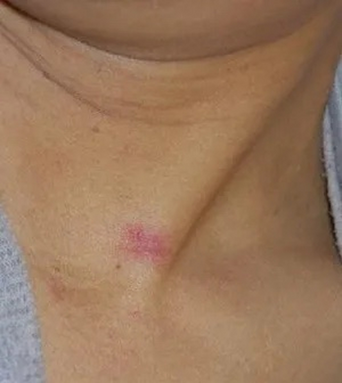 一位60岁的男性,从河南过来,在春节期间发现自己胸前出现了"蜘蛛痣"