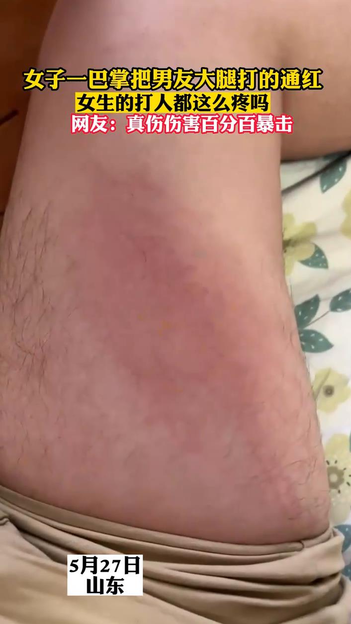 女子一巴掌把男友大腿打的通红,女生的打人都这么疼吗?