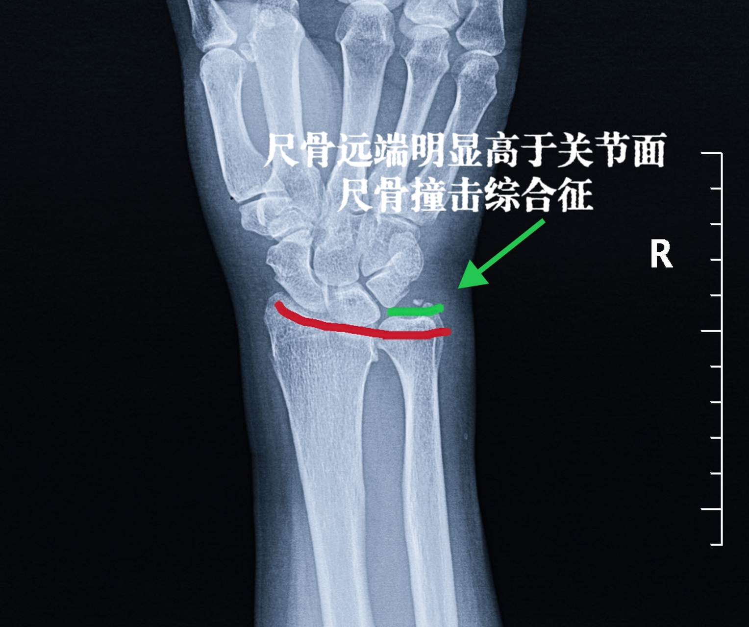 腕关节尺偏桡偏图片