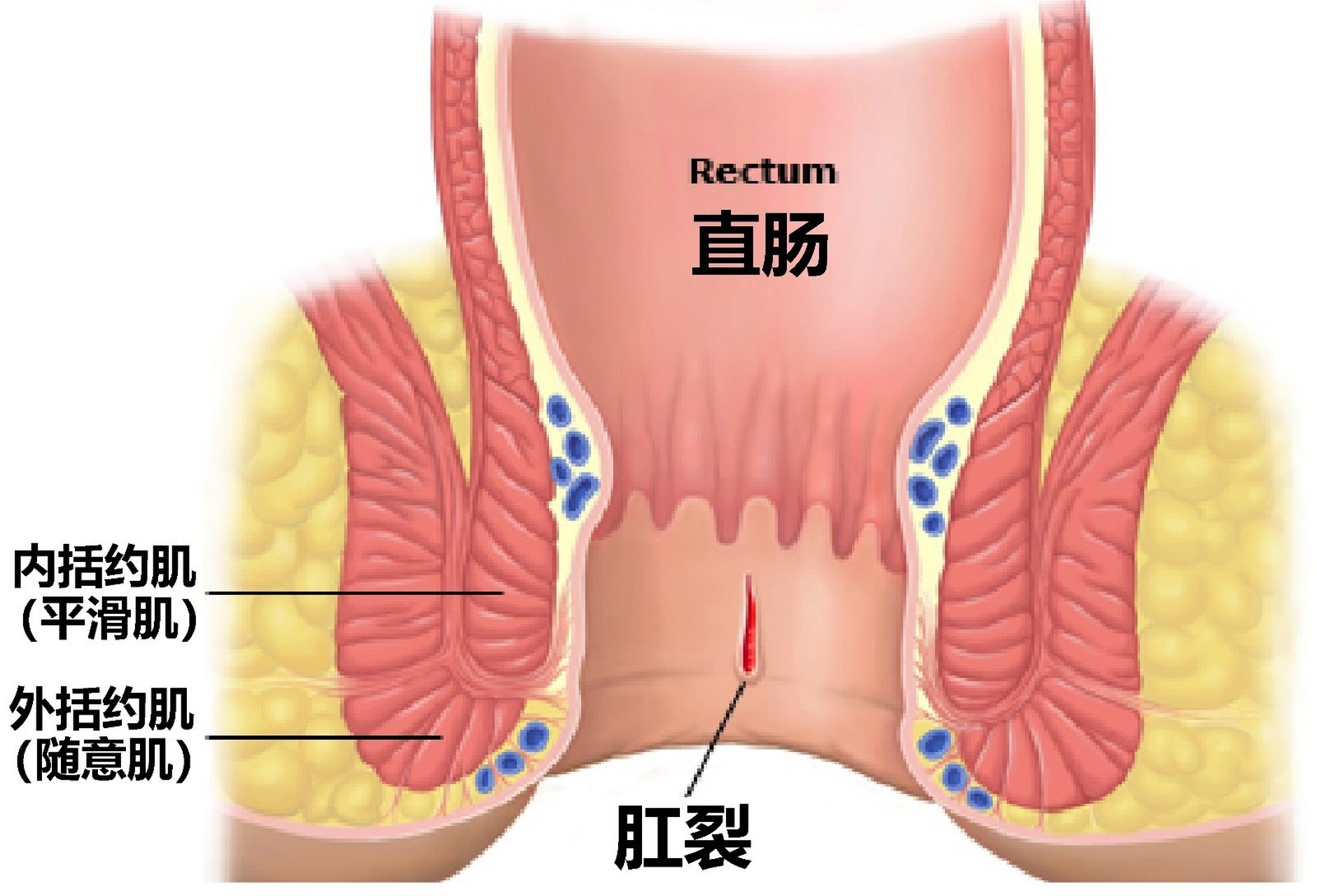 肛裂 毁三观图片