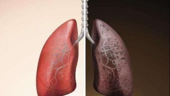每天一个鸡蛋,对肺部有何影响?若想肺健康,建议做好这4件事