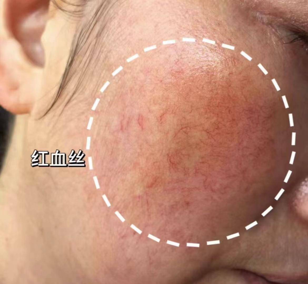 红血丝敏感肌必看!拒绝村气大红脸,教你养出盛世美颜!