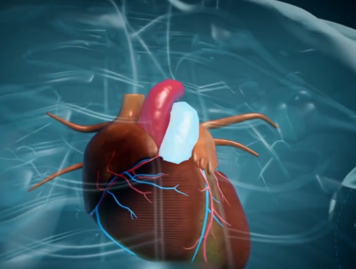 回顾27岁小伙心脏长肿瘤,医生开胸后"换心失败",父母