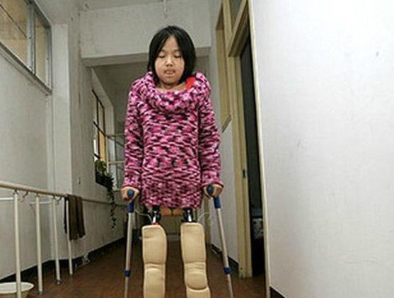 所以她刚安上假肢,那种不平衡的感觉,让钱虹艳无法走路.