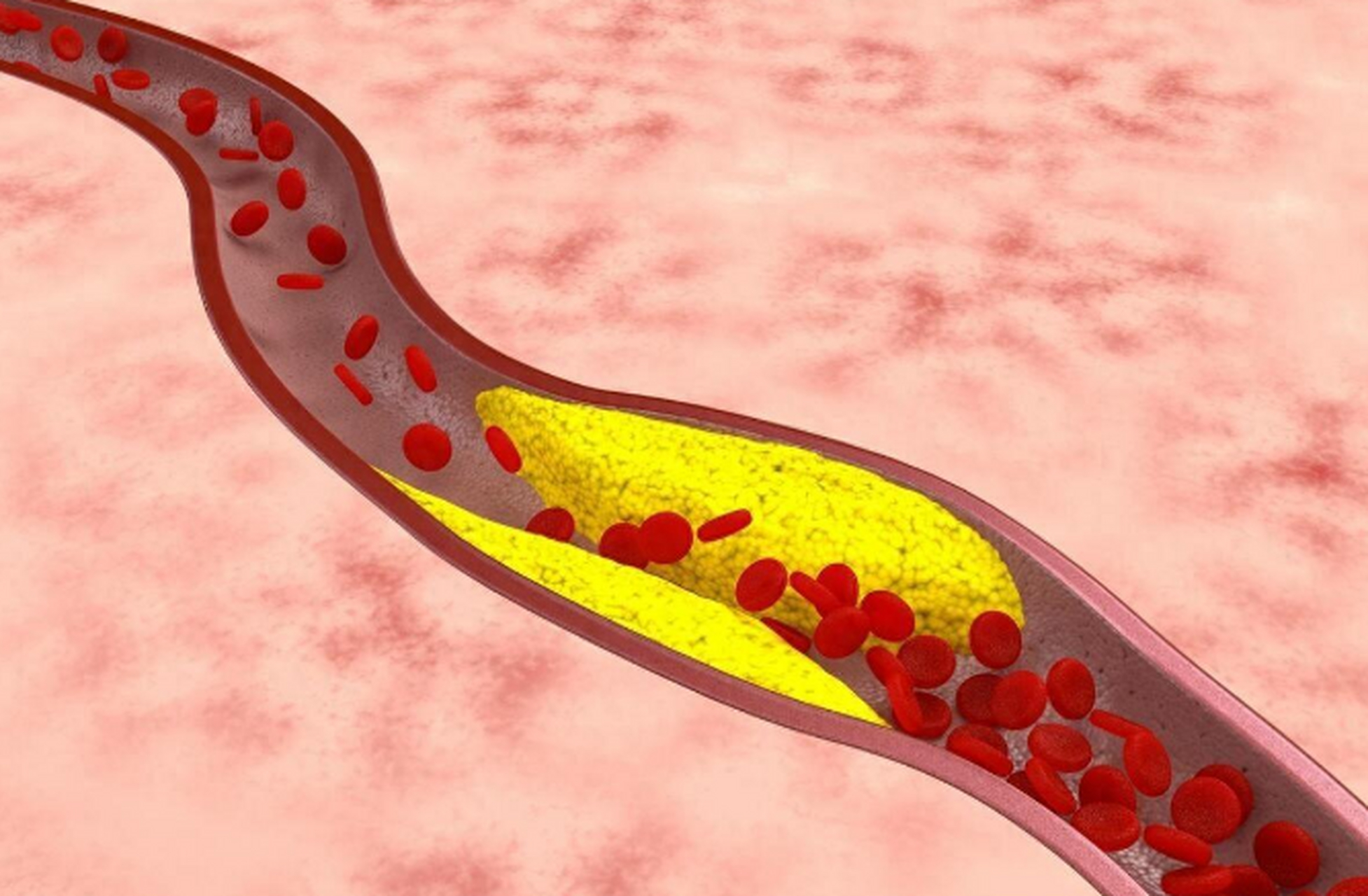 血液粘稠有4个信号,很多人不在意,血管就堵了  血液是人体内重要的