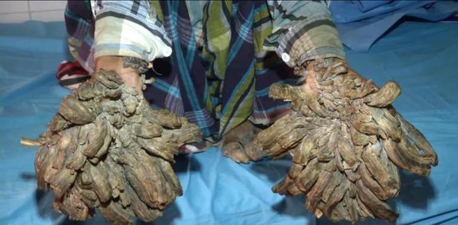 湖南出现一个怪人,手脚长满"枝枝",当地称他为树人,为何这样