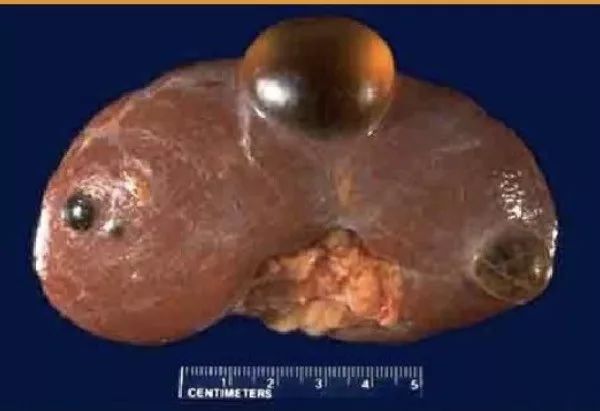 一文读懂多囊肾和肾囊肿如何鉴别附ct原图