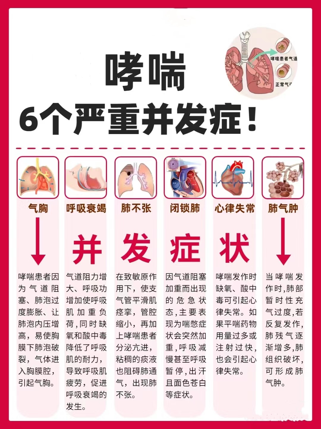 气胸:哮喘患者因为气道阻塞,肺泡过度膨胀,让肺泡内压增高,易使胸膜