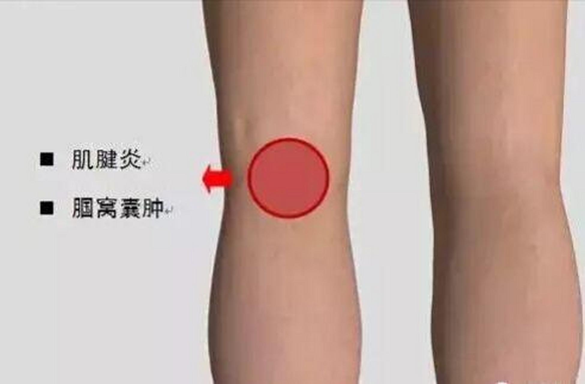 膝盖后窝疼,这5大原因最常见  第1,膝关节后方内外侧骨缝疼.