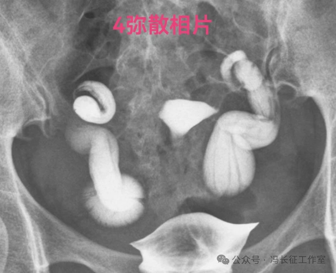 输卵管造影 积水图片