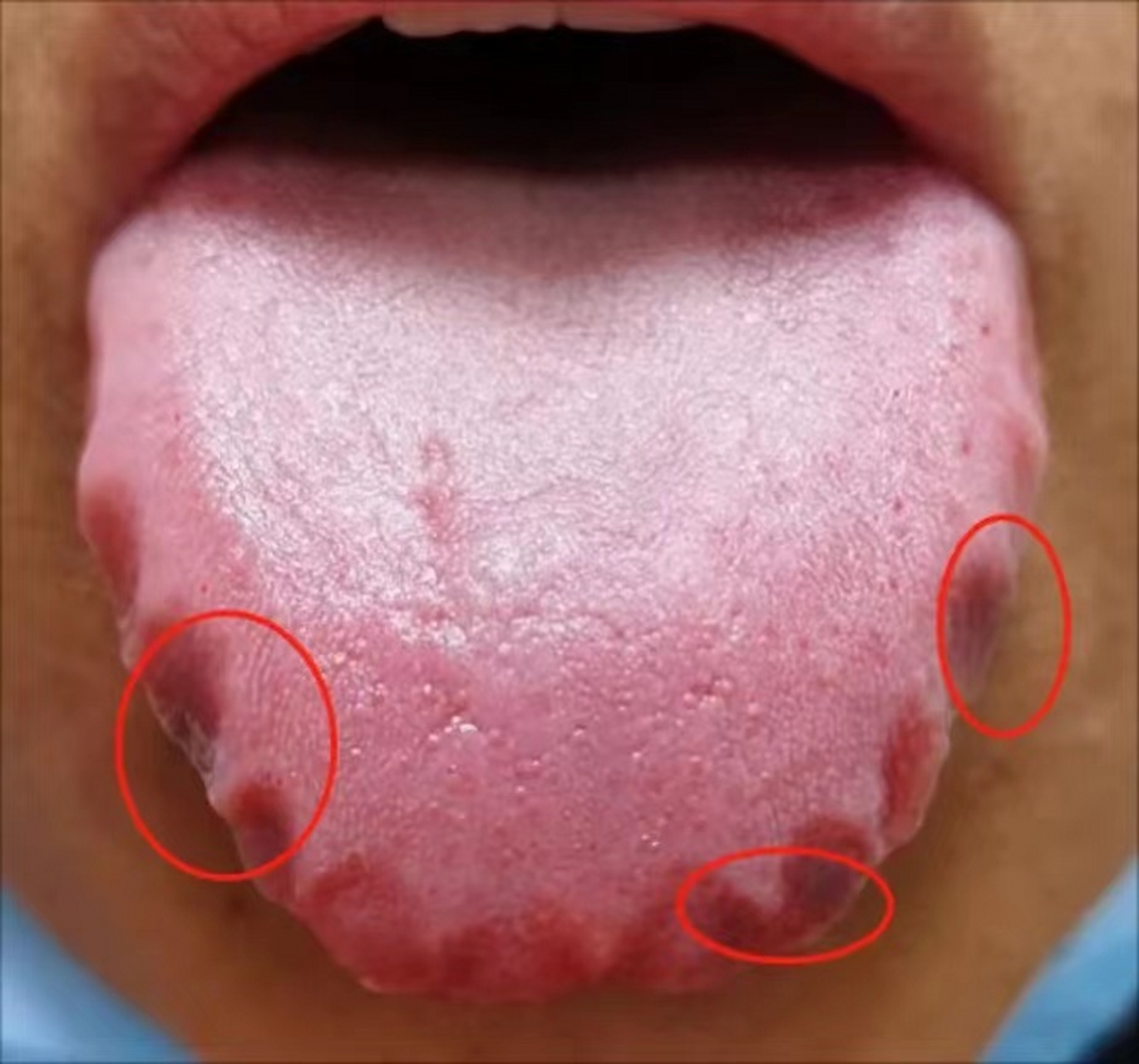 这种齿痕舌的严重程度,已经远超常人想象.