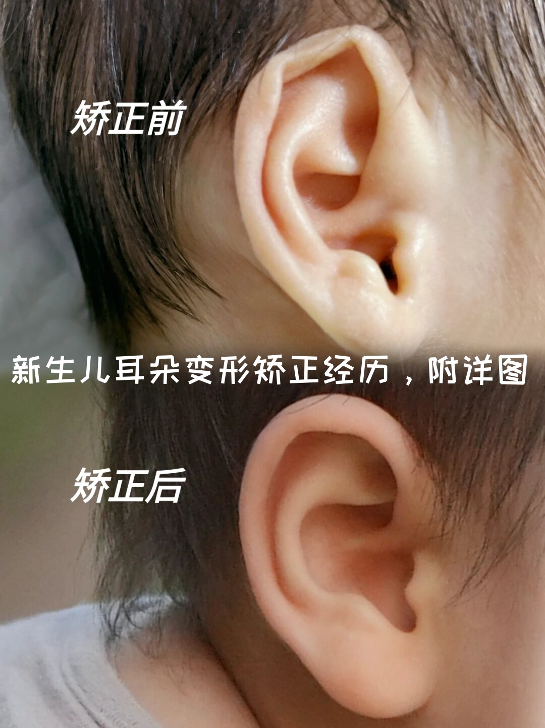 当我家小之儿呱呱坠地时,他的两只小耳朵就带着些挑战——耳廓畸形